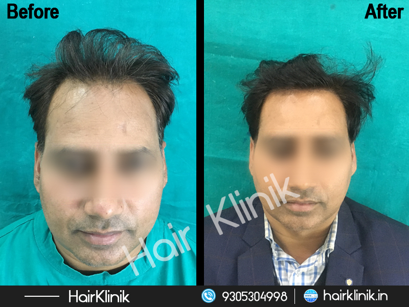 Hair Klinik - Lucknow