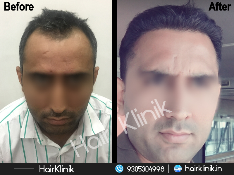 Hair Klinik - Lucknow